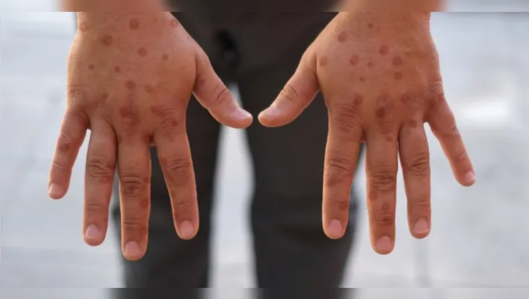 OMS faz importante alerta sobre Mpox: “emergência de saúde”