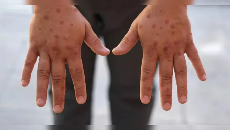 Primeiro caso de nova cepa do vírus Mpox é confirmado no Brasil