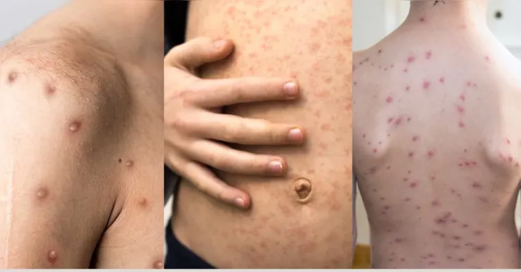 Entenda a diferença entre mpox, sarampo e catapora