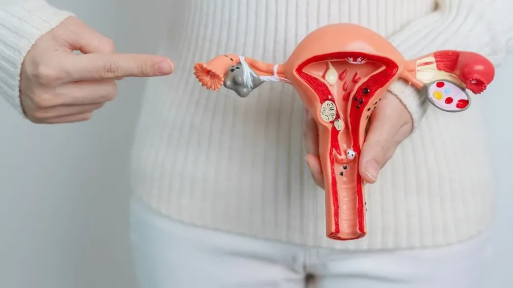 Miomas uterinos: veja sintomas, exames e formas de prevenção