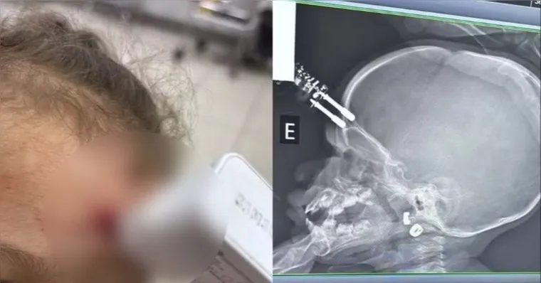 Bebê fica com carregador cravado na testa após cair da cama