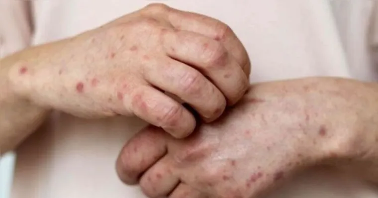 Nova cepa de Mpox no Brasil: veja o que o vírus faz com a pele